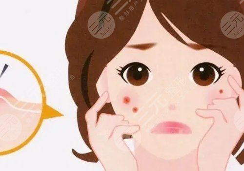 如何去除臉上的青春痘？