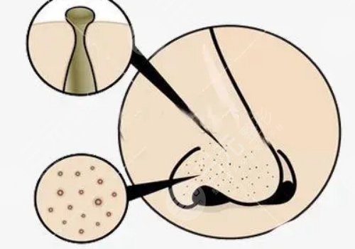 男性毛孔粗大油膩怎么改良？
