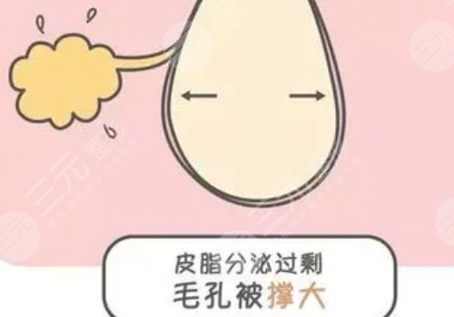 男性毛孔粗大油膩怎么改良？