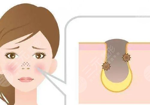 男性毛孔粗大油膩怎么改良？