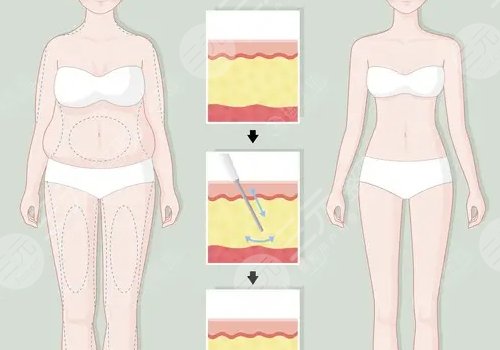 產(chǎn)后吸脂減肥好嗎？