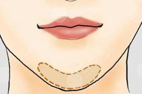 玻尿酸豐下巴會(huì)變形嗎？塑形效果理想嗎？注意事項(xiàng)都有哪些？