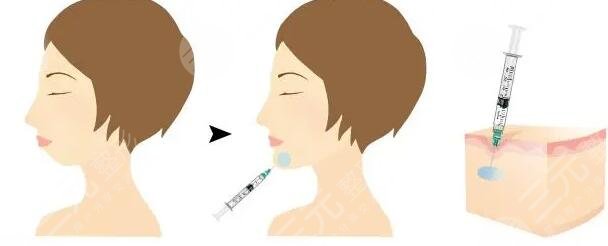 玻尿酸填充方便嗎?