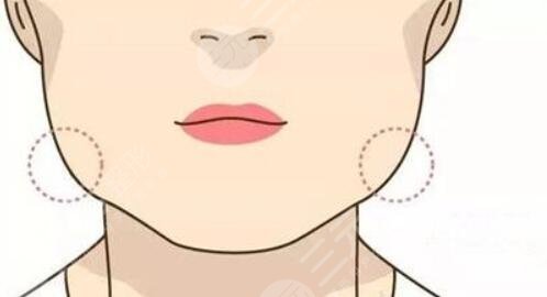 下頜角肥大怎么處理？有效的改良方式匯總，你適合哪種？