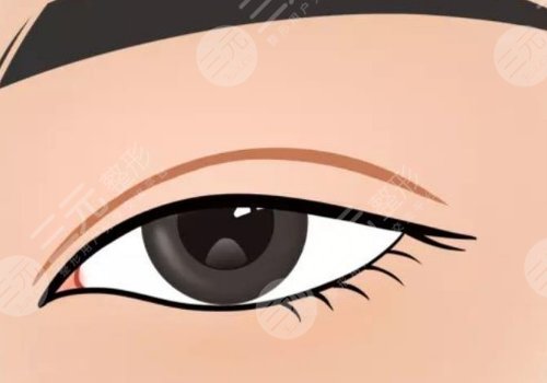 雙眼皮修復(fù)大概多少錢呢？