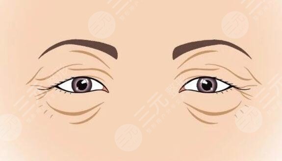 　　眼瞼皮膚松弛矯正術(shù)適合哪些人群?在開(kāi)展緩解之前，越來(lái)越多的人都咨詢(xún)過(guò)這個(gè)問(wèn)題，因?yàn)橥ㄟ^(guò)做該緩解，能夠讓眼部周?chē)募∧w更加的緊致和光滑，不會(huì)出現(xiàn)松弛的感覺(jué)，而且也能夠讓整個(gè)人的皮膚狀態(tài)看上去更加的美觀和協(xié)調(diào)。但是做完緩解之后也有可能會(huì)出現(xiàn)一些后遺癥，所以適用的人群是不同。那么，眼瞼皮膚松弛矯正術(shù)適合哪些人群?一起來(lái)看!  　　一、眼瞼皮膚松弛是什么?  　　上眼瞼松弛多由于上眼皮脂肪過(guò)多所致，整個(gè)人眼部周?chē)募∧w看上去是比較松弛的，沒(méi)有美觀的感覺(jué)。如果不進(jìn)行及時(shí)的緩解和改良的話(huà)，那么整個(gè)人的皮膚會(huì)變薄然后變松，整個(gè)人的肌膚彈性會(huì)越來(lái)越小，松弛的程度也會(huì)更加的嚴(yán)重，整個(gè)人體的皮膚也會(huì)產(chǎn)生一定的萎縮。  　　二、眼瞼皮膚松弛矯正術(shù)適合哪些人群?  　　矯正手術(shù)適合人群，其實(shí)是比較多元化的，而且并非單純從年齡角度考慮，主要是看人體的眼角以及眉毛的松弛程度，也要看外眥皮膚松弛情況、上瞼重瞼松弛情況，然后根據(jù)實(shí)際狀態(tài)制定針對(duì)性的手術(shù)方案，然后再判斷是否可以進(jìn)行矯正手術(shù)。  　　通過(guò)上瞼松弛矯正術(shù)，同時(shí)也可以通過(guò)眉上切口或眉下切口，能夠讓整個(gè)人的眼部協(xié)調(diào)感更好，同時(shí)能夠達(dá)到面部年輕化的效果，而且還能夠讓眼部周?chē)募∧w更加的緊致。隨著求美人士對(duì)面部美容的關(guān)注，這種緩解方式能夠讓受術(shù)者得到更好的調(diào)節(jié)，并且皮膚狀態(tài)也會(huì)更加的美觀。  　　1、上眼瞼松弛多見(jiàn)于中、老年人，所以說(shuō)這類(lèi)人群一般是比較適合的。隨著年齡的增長(zhǎng)，皮膚在慢慢的變薄，然后變得更加的松弛，所以說(shuō)肌膚也缺乏彈性，這類(lèi)人群的眼輪匝肌變性松弛、眼眶隔膜松弛萎縮，所以可以通過(guò)做該手術(shù)進(jìn)行一定的改良和調(diào)。  　　2、眼瞼松弛尤其是上眼瞼松弛這類(lèi)人群，也可以通過(guò)做這類(lèi)緩解，進(jìn)行一定的調(diào)節(jié)。嚴(yán)重的引起瞼裂變小，從而導(dǎo)致遮蓋瞳孔而影響視力影響視野，因此進(jìn)行一定的改良，能夠讓肌膚更加的緊致，而且也能夠讓生活更加的方便。有的可見(jiàn)倒睫毛刺激眼球引起不適，通過(guò)做該手術(shù)可以更好的改良。眼瞼松弛影響美觀，也影響視野，所以做了這類(lèi)緩解之后，皮膚也會(huì)更加的緊致，皺紋也會(huì)越來(lái)越少。  　　三、眼瞼皮膚松弛矯正術(shù)注意事項(xiàng)  　　上眼瞼松弛影響美觀影響視野，可以在專(zhuān)業(yè)醫(yī)生的指導(dǎo)下做手術(shù)進(jìn)行一定的調(diào)節(jié)，但是一定要進(jìn)行術(shù)前的檢查然后根據(jù)自己的實(shí)際狀態(tài)進(jìn)行操作。手術(shù)后遵從醫(yī)囑，及時(shí)使用抗炎藥物，不能夠吃太多辛辣刺激性以及油膩的食物，避免感染發(fā)生，定期眼科檢查，如果出現(xiàn)了問(wèn)題也要進(jìn)行及時(shí)的緩解，而且傷口不能夠沾水，否則可能也會(huì)出現(xiàn)感染的。  　　做完緩解之后不能夠用力按壓自己肌膚，否則有可能會(huì)出現(xiàn)劇烈的疼痛感，還有可能會(huì)出現(xiàn)炎癥的現(xiàn)象，因此一定要進(jìn)行針對(duì)性的護(hù)理，才能夠讓整個(gè)人的眼部周?chē)募∧w更加的緊致，一旦出現(xiàn)了松弛，就要進(jìn)行及時(shí)的干預(yù)和改良。日常生活中也要早一點(diǎn)休息，盡量減少熬夜，才能夠讓整個(gè)人的皮膚更加的健康。在熬夜的過(guò)程中，可能會(huì)出現(xiàn)內(nèi)分泌系統(tǒng)失調(diào)，周?chē)募∧w狀態(tài)也會(huì)更加的衰老，還有可能會(huì)出現(xiàn)皺紋加重的現(xiàn)象，因此一定要早睡早起，調(diào)節(jié)好生活作息時(shí)間。