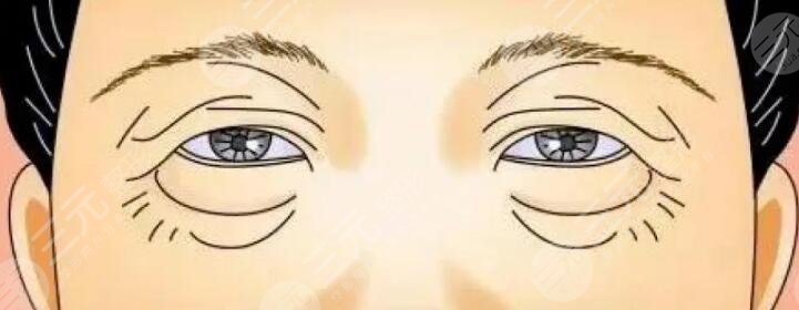 眼瞼皮膚松弛矯正術(shù)注意事項(xiàng)