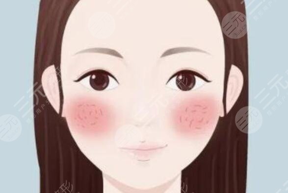 臉上紅血絲泛紅怎么辦?