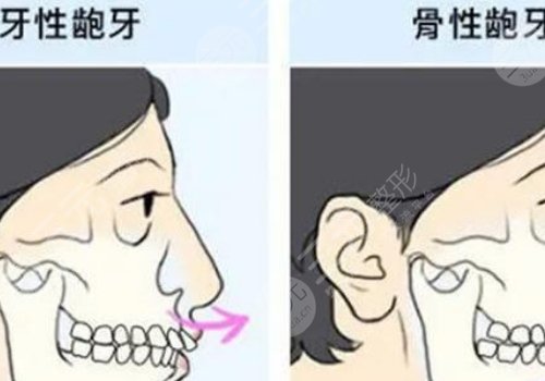 嘴凸怎么辦？