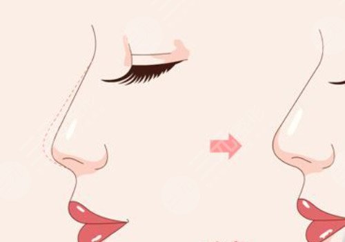 媽生鼻和直鼻微翹的區(qū)別是什么？