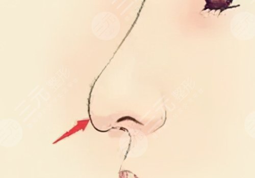 媽生鼻和直鼻微翹的區(qū)別是什么？