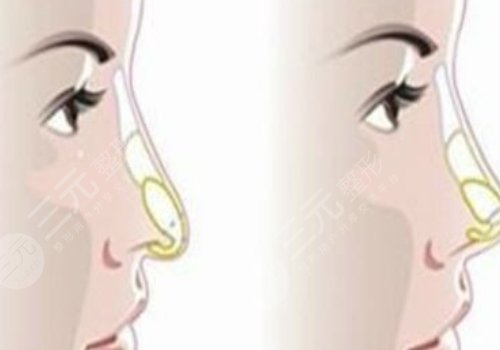 媽生鼻和直鼻微翹的區(qū)別是什么？