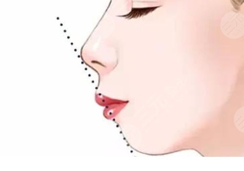 嘴凸是怎么造成的？