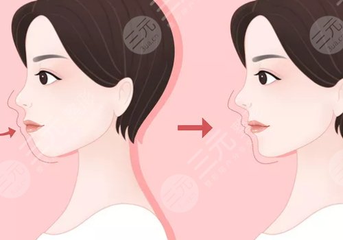 嘴凸是怎么造成的？