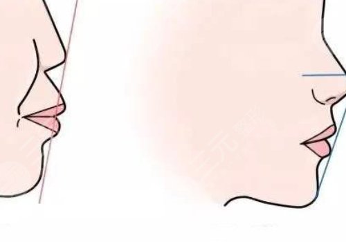 嘴凸是怎么造成的？