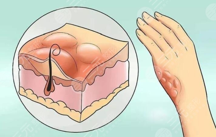 像素激光去疤痕要做多少次才會好？項目定價、注意事項有哪些？