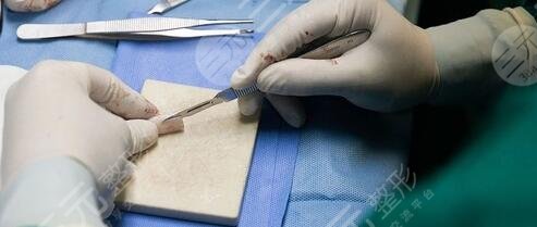 自體軟骨隆鼻有缺點(diǎn)嗎?