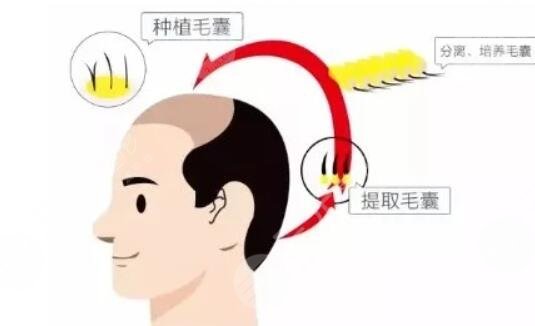 毛發(fā)種植手術費用是多少?