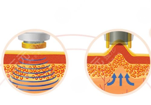 像素射頻儀器祛疤有用嗎？