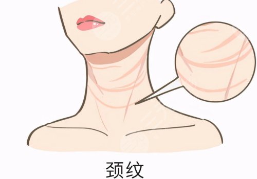 頸紋特別深怎么去除？