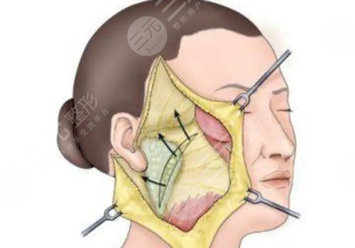 拉皮手術多大年齡做合適？