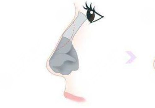 肋骨隆鼻肋骨取了對(duì)身體有影響嗎？