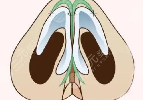 肋骨隆鼻肋骨取了對(duì)身體有影響嗎？