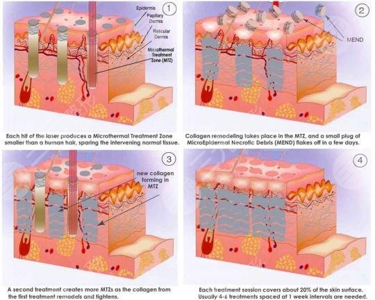 像素射頻儀器祛疤有用嗎？