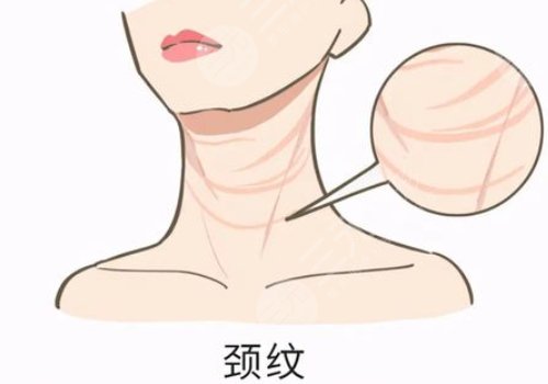 頸紋是什么原因造成的？