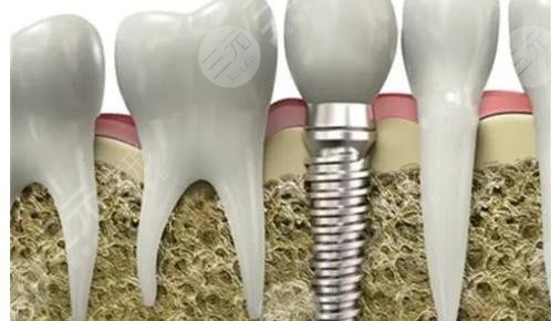 種植牙