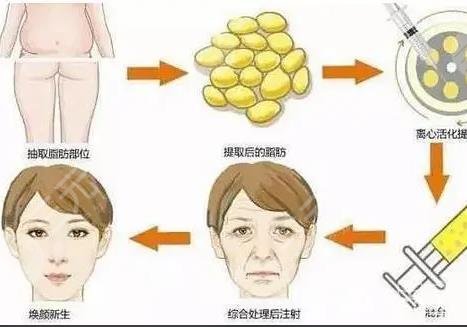 玻尿酸豐面頰好還是自體脂肪好？