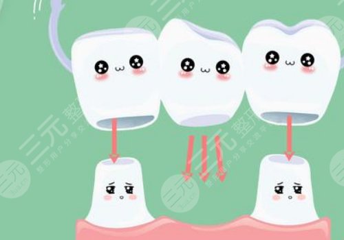 鈦合金烤瓷牙多少錢(qián)一顆？