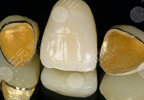 鈦合金烤瓷牙多少錢(qián)一顆？