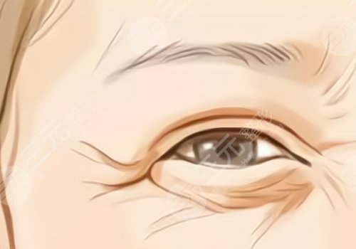 魚尾紋怎么才能去掉？