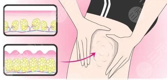 怎么樣才可以溶脂減肥?