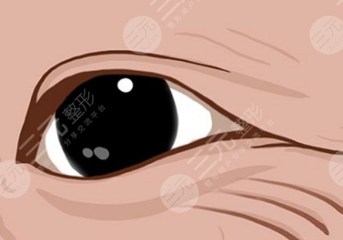 怎么樣去除眼部皺紋？