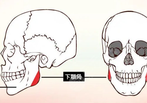 下頜角寬大怎么改良？