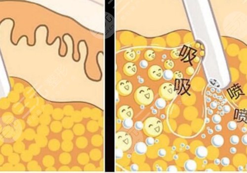 腹部抽脂術(shù)后需要修復(fù)多久？