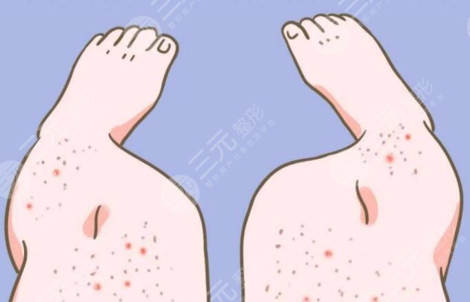 雞皮疙瘩皮膚怎么治比較好？雞皮疙瘩皮膚形成原因及日常護(hù)理