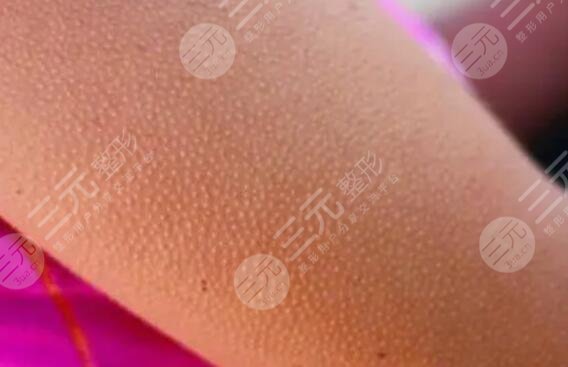 出現(xiàn)雞皮疙瘩應(yīng)該注意哪些問題?