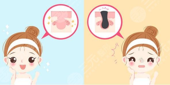 激光緩解鼻子痤瘡注意事項有哪些?