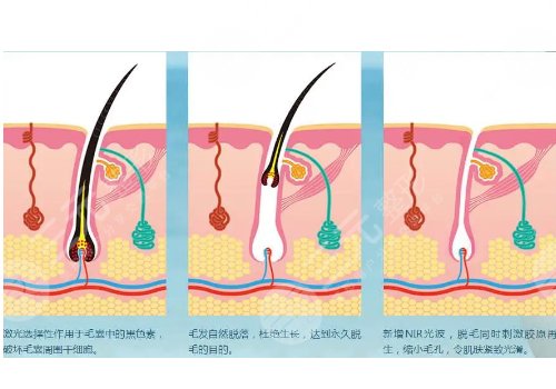 男士激光脫毛效果如何？