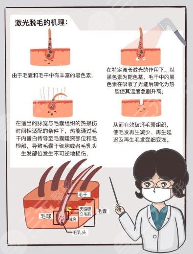 男士激光脫毛效果如何？