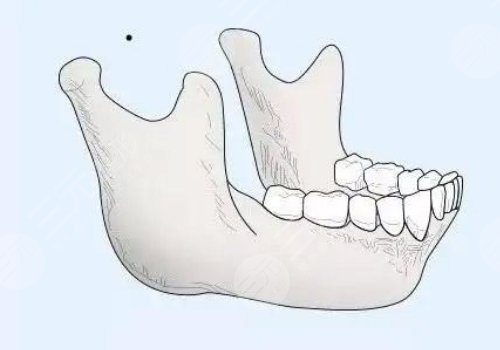 下頜角寬大怎么改良？