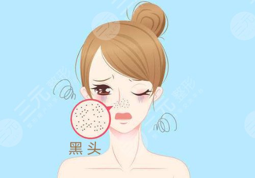 黑頭怎么去除有效？