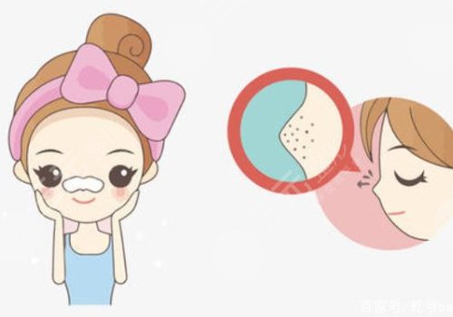 黑頭怎么去除有效？