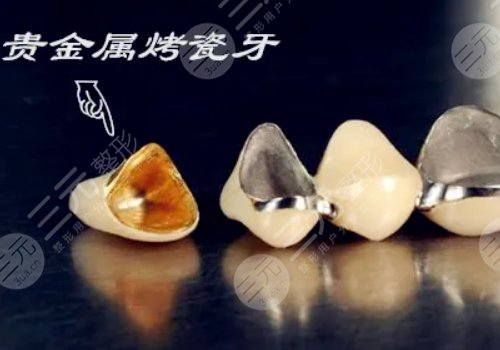 烤瓷牙多少錢一顆？