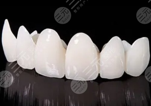 烤瓷牙多少錢一顆？