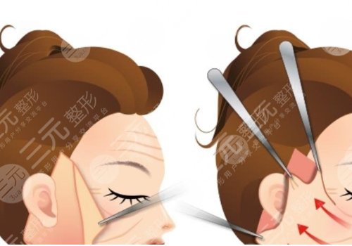 拉皮手術(shù)多大年齡做合適？