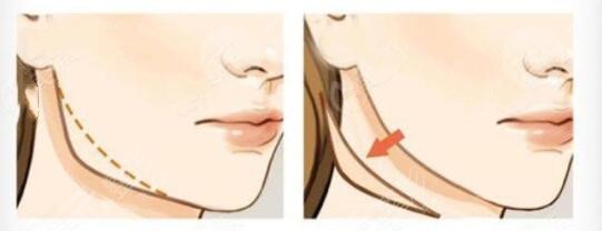 上海美聯(lián)臣醫(yī)療美容醫(yī)院熱門項目